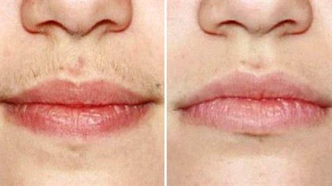 Τριχοφυΐα στο πρόσωπο: 5 τρόποι για να απαλλαγείτε φυσικά